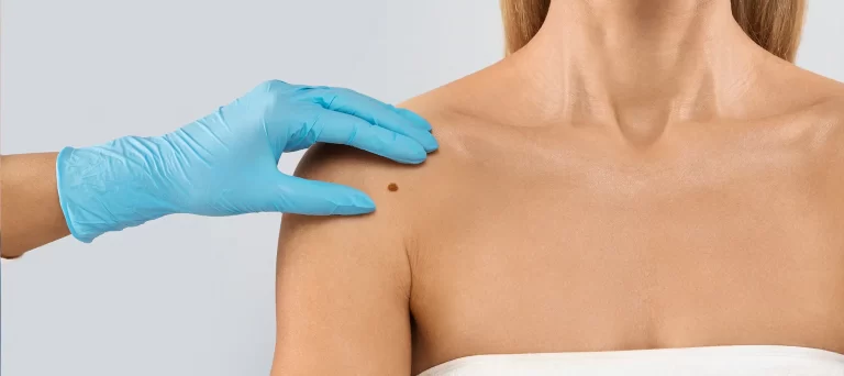 Bothered by a Skin Tag? Here’s How Jenhams Clinic Can Help You Remove It Safely